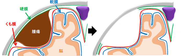 脳腫瘍 | 町田の脳神経外科・脊髄外科・神経内科「町田脳神経外科」