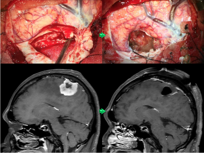 脳腫瘍 | 町田の脳神経外科・脊髄外科・神経内科「町田脳神経外科」