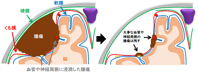 脳腫瘍 | 町田の脳神経外科・脊髄外科・神経内科「町田脳神経外科」